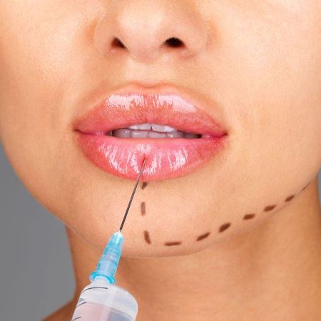  Контурная пластика губ препаратом ART FILLER Lips
