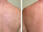 Лазерная эпиляция диодным лазером "Diolaze" зона спины (мужчины)