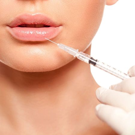 Увеличение губ препаратом Juvederm Ultra Smile (0,55 мл)