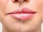 Контурная пластика губ Stylage Lips\Stulage M с лидокаином 1 мл