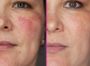 Лечение сосудистых образований на лице (купероз) Лицо полностью