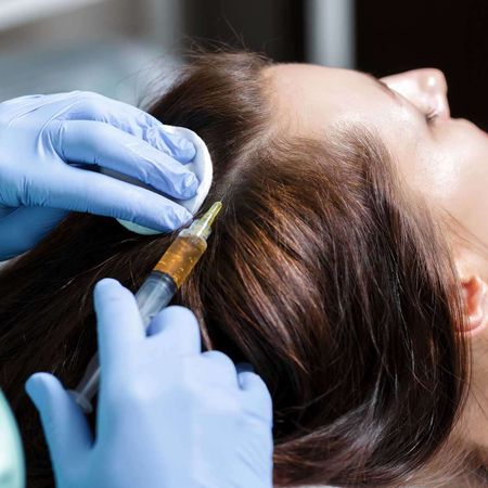 Биоревитализация препаратом Plinest Fast (2 мл): волосистая часть кожи головы