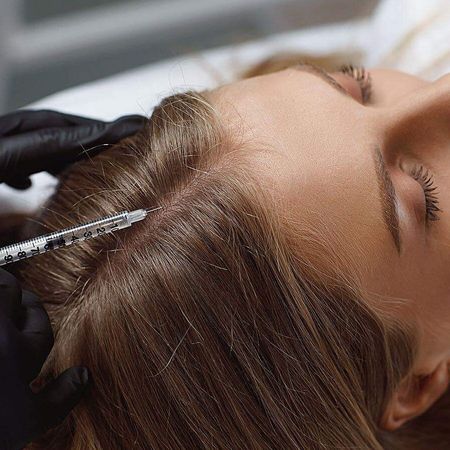 Мезотерапия препаратом Fusion Meso F-Hair (5 мл): волосистая часть кожи головы