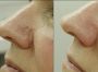 Лечение сосудистых образований на лице (купероз) крылья носа