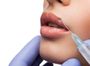 Контурная пластика губ препаратом Belotero Lips Contour 0.6 мл