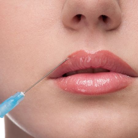 Увеличение губ препаратом Art Filler Lips (2 мл)