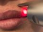  Удаление татуаж  на неодимовом лазере область  губы (в стоимость услуги включина анестезия.)