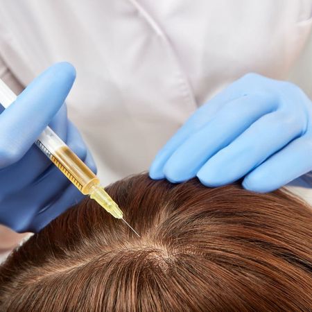 Мезотерапия контроль над потерей волос препаратом Hair Loss