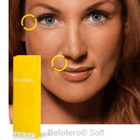Контурная пластика препаратом Belotero Soft (1 мл)