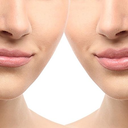 Увеличение губ препаратом Stylage Special Lips (1 мл)