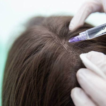 Мезотерапия препаратом Hair X DNA Peptid (2 мл): волосистая часть кожи головы