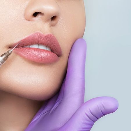 Увеличение губ препаратом Juvederm Ultra Smile (0,55мл)