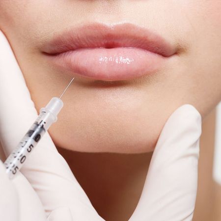 Увеличение губ препаратом Art Filler Lips с лидокаином (1 мл)