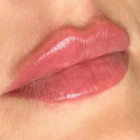 Увеличение губ препаратом Juvederm Ultra Smile (0,55мл)