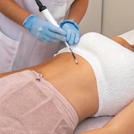 Контурная пластика препаратом Mesoheal Body HA Filler (60 мл)
