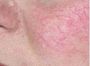Лечение сосудистых образований на лице (купероз) Зона щеки+нос