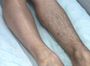 Лазерная эпиляция для мужчин ноги полностью