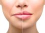 Smooth Lips - омоложение периоральной зоны и коррекции губ