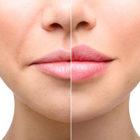 Увеличение губ препаратом Stylage Special Lips (1 мл)