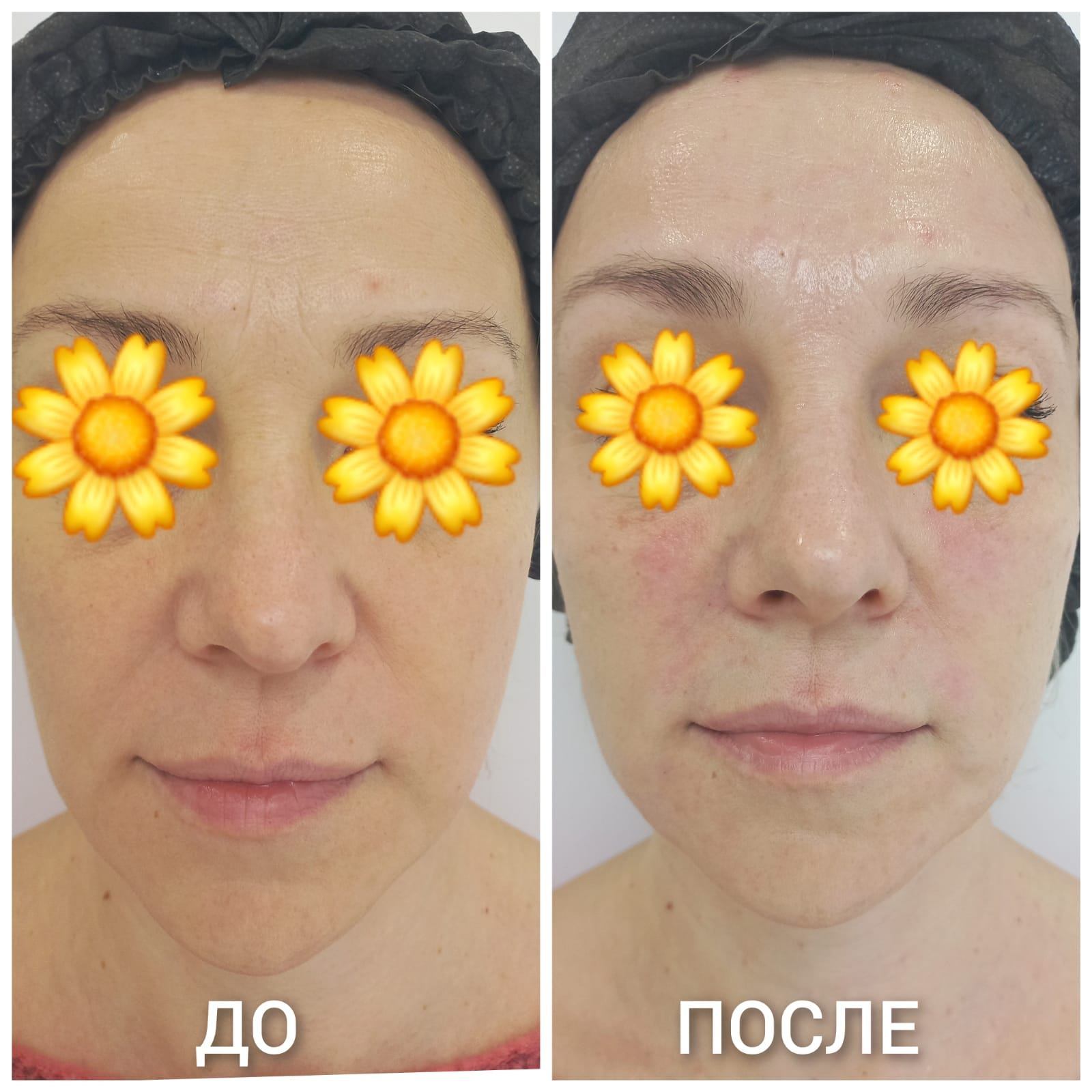 Биоревитализация Meso-Xanthin (Мезоксантин) в Москве