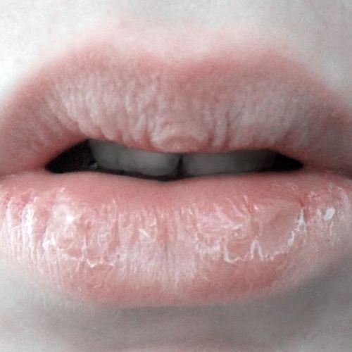 Сухость губ